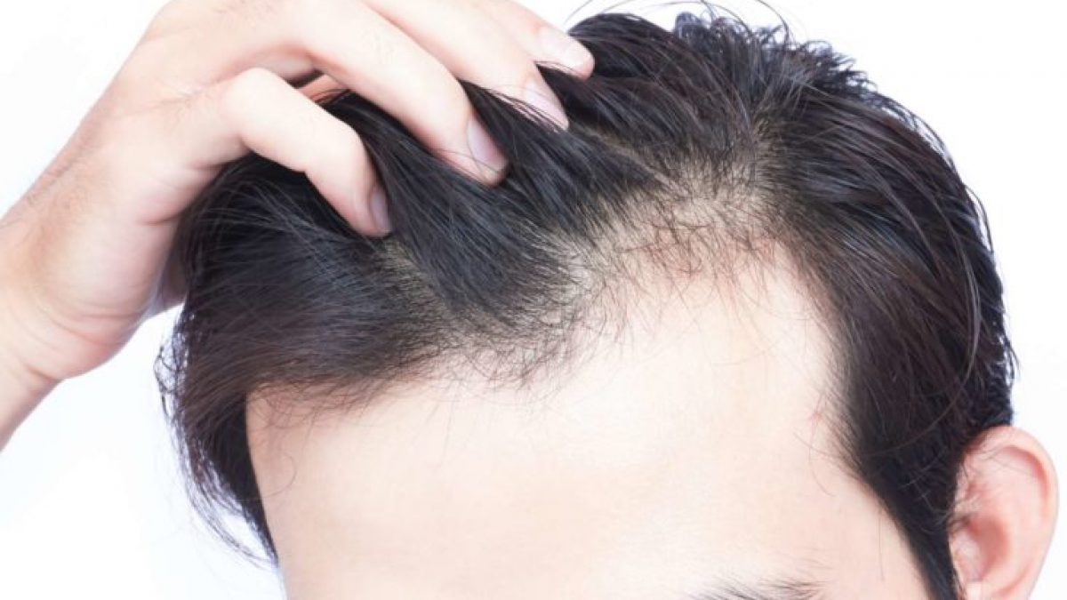 Thuốc trị rụng tóc thuốc mọc tóc nhanh cho nam nào hiệu quả  Rungtocvn