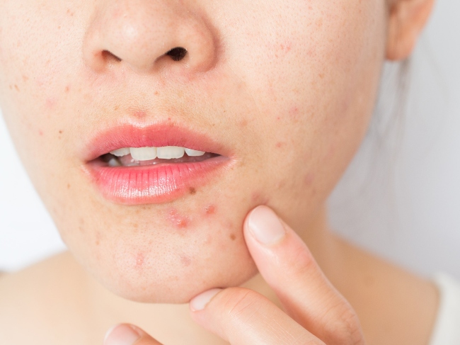 tác dụng của cao chè vằng