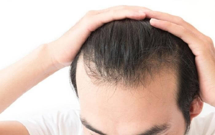 nguyên nhân gây rụng tóc ở nam giới