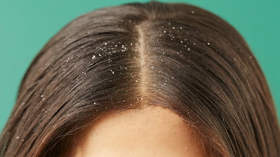 Tóc bị gàu  nguyên nhân và cách điều trị  Hương Bùi Store