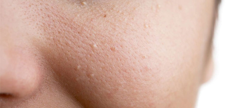 5 Cách vệ sinh da mặt khi bị mụn đúng cách ngay tại nhà