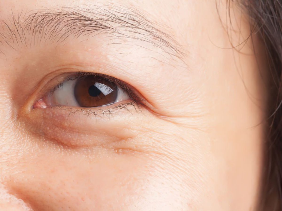 Nhăn da vùng mắt là hiện tượng gì? Đâu là nguyên nhân gây nhăn da vùng mắt